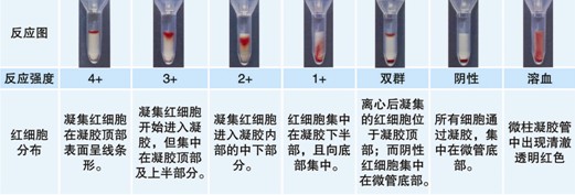 【試驗(yàn)?zāi)康暮驮怼? ABO血型鑒定是通過檢測被檢者紅細(xì)胞上是否存在A和/或B抗原(正定型)以及被檢者血漿中是否存在抗A和/或抗B抗體(反定型)來確定。 對于成年個(gè)體被檢者,紅細(xì)胞上的A和/或B抗原與血漿中的抗A和/或抗B抗體存在一種對應(yīng)關(guān)系。其獨(dú)特性質(zhì)在于:紅細(xì)胞上缺乏A和/或B抗原,則血清中存在與所缺乏的抗原對應(yīng)的強(qiáng)反應(yīng)性抗體,如紅細(xì)胞上缺乏A抗原,則可以預(yù)見血漿中存在抗A抗體。 常規(guī)的ABO定型必須包括正定型(紅細(xì)胞定型)和反定型(血漿定型),并將正反定型結(jié)果相互驗(yàn)證,只有正反定型結(jié)果一致時(shí)才能準(zhǔn)確定型。 Rh陽性和Rh陰性的鑒定是通過檢測被檢者的紅細(xì)胞上是否有D抗原,有D抗原為Rh陽性,沒有D抗原則為Rh陰性。 ABO/RhD血型定型檢測試劑卡采用凝膠作為微柱凝膠卡的填充物,將生物化學(xué)的凝膠分子篩過濾技術(shù)、離心技術(shù)和血型血清學(xué)的抗體特異性結(jié)合在一起,其中 抗A凝膠管中灌注了含抗A抗體的凝膠,抗B凝膠管中灌注了含抗B抗體的凝膠,抗D凝膠管中灌注了含IgM抗D抗體的凝膠。A細(xì)胞、B細(xì)胞及Ctl管中灌注 了不含血型抗體的凝膠,抗A、抗B及抗D凝膠管用于紅細(xì)胞上A、B及D抗原檢測,而A細(xì)胞、B細(xì)胞用于檢測血漿中的抗體,Ctl管用于自身對照。當(dāng)抗原抗 體反應(yīng)時(shí),凝集的紅細(xì)胞在離心力的作用下不能通過凝膠而留在凝膠上層或游離在凝膠中,呈現(xiàn)陽性反應(yīng);而抗原抗體沒有反應(yīng)時(shí),未凝集的紅細(xì)胞在離心力的作用 下可通過凝膠而沉積在微柱凝膠管的底部,呈現(xiàn)陰性反應(yīng)。 20121212104122758.jpg 【ABO/RhD血型定型檢測試劑卡的用途】 1.?用于輸血前檢測 (1) 鑒定ABO血型,以備選擇ABO血型相配合的血液用于交叉配血。 (2) 鑒定RhD血型,以備選擇RhD血型相配合的血液用于交叉配血。 2.?用于圍產(chǎn)期檢查 (1)?用于產(chǎn)前夫婦的ABO、RhD血型檢測,進(jìn)行新生兒溶血病產(chǎn)前預(yù)測。 (2)?用于產(chǎn)后母子的ABO、RhD血型檢測,進(jìn)行新生兒溶血病產(chǎn)后診斷。 3.?用于常規(guī)ABO、RhD血型化驗(yàn)檢查,如健康體檢等。 【樣本要求】 1.?建議使用抗凝的血樣,尤其是EDTA抗凝管采集的血樣,需要量2ml 。(EDTA抗凝采血管為紫帽管)。 2.?血液樣本在采集后48小時(shí)以內(nèi)檢測。 【所需儀器設(shè)備及耗材】 1.?ABO、RhD血型定型檢測試劑卡 2.?血型血清學(xué)離心機(jī)(用于離心分離血漿、洗滌紅細(xì)胞) 3.?微柱凝膠卡離心機(jī) 4.?微量移液槍及吸頭 【試驗(yàn)操作】? 按照下列步驟進(jìn)行操作 一、被檢血液樣本的處理及反定型A型、B型紅細(xì)胞的準(zhǔn)備 1.?EDTA抗凝的血液樣本離心3000rpm 1分鐘,將上清血漿轉(zhuǎn)入一支12×75mm 試管中,余下的壓積紅細(xì)胞備用。如果血漿有不溶物(如混入的紅細(xì)胞)或不澄清透明,則需要將血漿再次離心,直到澄清透明不含不溶物為止。 2.?另取一支12×75mm試管中,加入0.1ml上述步驟1中的壓積紅細(xì)胞 ,用生理鹽水洗滌一次,棄上清,得到壓積紅細(xì)胞。 3.?在一支12×75mm試管中,加入1ml生理鹽水(或LISS液),加入步驟2中得到的壓積紅細(xì)胞10μl,混勻得到0.8~1%的被檢紅細(xì)胞懸液。 4.?將反定型A型、B型紅細(xì)胞用生理鹽水或LISS液配制成0.8~1%濃度。 二、ABO、RhD定型 1.?取ABO/RhD血型定型檢測試劑卡一片,注意檢查外觀,確保凝膠管的凝膠上層存在液面,凝膠不會干涸。將符合要求的卡進(jìn)行標(biāo)記,按照試驗(yàn)需要撕開封口膜。 2.?用微量移液槍分別向抗A、抗B、抗D孔及Ctl孔的每孔樣品槽中沿樣品槽內(nèi)壁呈45°角緩慢加入50μl 0.8~1%濃度的被檢者紅細(xì)胞懸液。 3.?向A細(xì)胞孔中加入50μl?0.8~1%的A型紅細(xì)胞懸液。 4.?向B細(xì)胞孔中加入50μl?0.8~1%的B型紅細(xì)胞懸液。 5.?分別向A細(xì)胞、B細(xì)胞、Ctl孔中加入25μl 被檢者血漿。 6.?在臺面交替輕扣卡左下角和右下角,確保所加入的液體在卡的樣品槽中呈水平狀態(tài),而不是偏向一側(cè)。 7.?將卡放入微柱凝膠卡離心機(jī)離心,LB-3000低速離心機(jī)第一檔離心900rpm 2分鐘,再1500rpm 3分鐘,判讀結(jié)果并記錄。 【結(jié)果判讀及解釋】 1.?反應(yīng)陰、陽性的判讀 20121212104153407.jpg 【注意事項(xiàng)】 1. 建議在使用凝膠卡前先離心再應(yīng)用。 2. 若凝膠卡封口開裂、孔中凝膠干涸或有氣泡,不可使用。 3. 撕開凝膠卡封口膜時(shí),不能用力過猛,以免造成凝膠微孔間的交叉污染。 4. 樣本采集后應(yīng)盡快檢測,若試驗(yàn)需要延遲,應(yīng)將樣本置2~8℃下短期儲存。 5. 紅細(xì)胞懸液的濃度為0.8~1%,濃度過高或過低會影響檢測結(jié)果。 6. 溶血、脂血、細(xì)菌污染等情況的標(biāo)本會影響檢測結(jié)果。 7. 血漿或血清標(biāo)本須充分離心去除纖維蛋白,否則會阻止紅細(xì)胞在微柱凝膠中的沉降,出現(xiàn)假陽性。 8. 人源血液樣本存在潛在的傳染性,凝膠卡使用后按醫(yī)療生物垃圾處理。 9. 在Ctl孔(自身陰性對照)結(jié)果為陽性時(shí),試驗(yàn)結(jié)果無效。可能原因是由于被檢紅細(xì)胞已經(jīng)致敏IgM抗體導(dǎo)致自發(fā)凝集,此時(shí)可以用DTT將已經(jīng)致敏到紅細(xì)胞上的IgM抗體破壞后再行 ABO、RhD血型檢測。 10. 抗D凝膠不能鑒定弱D、部分D(如DⅥ)抗原。對于患者,如果抗D凝膠管中患者的紅細(xì)胞反應(yīng)為陰性,則確定為RhD陰性。 11. 若出現(xiàn)<2+的弱陽性反應(yīng),須做進(jìn)一步試驗(yàn)才能準(zhǔn)確定型,即確認(rèn)弱反應(yīng)是由于被檢者的抗原減弱還是凝膠微孔之間的交叉污染引起。 12. 若出現(xiàn)混合視野反應(yīng),需要了解被檢者近期3個(gè)月內(nèi)是否有輸血史,或被檢者是否為骨髓移植患者。 13. 由于6月齡以下的嬰兒其血漿/血清中不似成人一樣存在可預(yù)見的抗A/抗B抗體,因此只做正定型不做反定型。 【ABO正反定型不一致原因分析】 如果血型定型正反定型結(jié)果不一致時(shí),則不能準(zhǔn)確定型,需要分析產(chǎn)生不一致的原因。 引起正反定型不一致的原因如下: (一)正定型出現(xiàn)弱反應(yīng)或缺失抗原 1. A亞型、B亞型或AB亞型。 2. 白血病導(dǎo)致A或B抗原減弱。 3. 何杰金病(Hodgkin’s)有時(shí)會抑制抗原表達(dá),與白血病類似。 4. 由于某種疾病(如腹腔癌、胰腺癌)導(dǎo)致血漿中存在大量的血型物質(zhì),中和抗A或抗B抗體,引起正定型為假陰性或弱陽性。 需要將正定型的紅細(xì)胞用生理鹽水洗滌后再次定型可解決此問題。 5. 骨髓移植。 6. 非ABO同型輸血。 (二)正定型紅細(xì)胞上多余的抗原反應(yīng) 1. 自身凝集紅細(xì)胞、抗體致敏紅細(xì)胞導(dǎo)致。 2. 細(xì)胞未洗滌,血漿蛋白引起的假陽性反應(yīng)。 3. 細(xì)胞未洗滌,血漿中存在針對正定型試劑中某種成分的抗體導(dǎo)致。 4. 骨髓移植。 5. 獲得性B。 6. B(A)現(xiàn)象。? 7. ABO非相合輸注。? (三)正定型出現(xiàn)混合視野反應(yīng)? 1. 近期輸血。? 2. 骨髓移植。? 3. 異卵雙胞胎或雙受精卵產(chǎn)生的嵌合體。? 4. 胎兒和母體出血。? (四)反定型血清中出現(xiàn)弱反應(yīng)或反應(yīng)缺失? 1. 年齡相關(guān):新生兒以及小于6月齡的嬰兒以及老年人。? 2. ABO亞型有亞型抗體,如A2、A2B型人的抗A1。? 3. 低球蛋白血癥(如白血病人、使用免疫抑制劑患者、免疫缺陷患者)。? 4. 移植患者使用抗排異藥物。? 5. 雙胞胎或雙受精卵產(chǎn)生的嵌合體。? (五)反定型出現(xiàn)多余的抗體反應(yīng)? 1. 冷自身抗體。? 2. 特異性冷同種抗體A。? 3. 血清中存在針對試劑紅細(xì)胞保存液成分的抗體。? 4. 某些疾病導(dǎo)致球蛋白水平增高(多發(fā)性骨髓瘤、巨球蛋白血癥、Hodgkin’s 淋巴瘤)引起緡錢狀凝集。 5. 輸用大分子血漿擴(kuò)容劑。? 6. 非ABO同型的移植。? 7. 靜脈注射免疫球蛋白。? (六)技術(shù)方面的錯(cuò)誤? 1. 血液樣本被污染,如混入其他人樣本。? 2. 被檢紅細(xì)胞的濃度過高或過低。? 3. 忘記在反應(yīng)體系中加入檢測樣本或試劑。? 4. 未按照試劑使用說明進(jìn)行試驗(yàn)。? 5. 離心步驟離心時(shí)間不足或離心時(shí)間超時(shí)。? 6. 對試驗(yàn)結(jié)果記錄或判讀不正確。